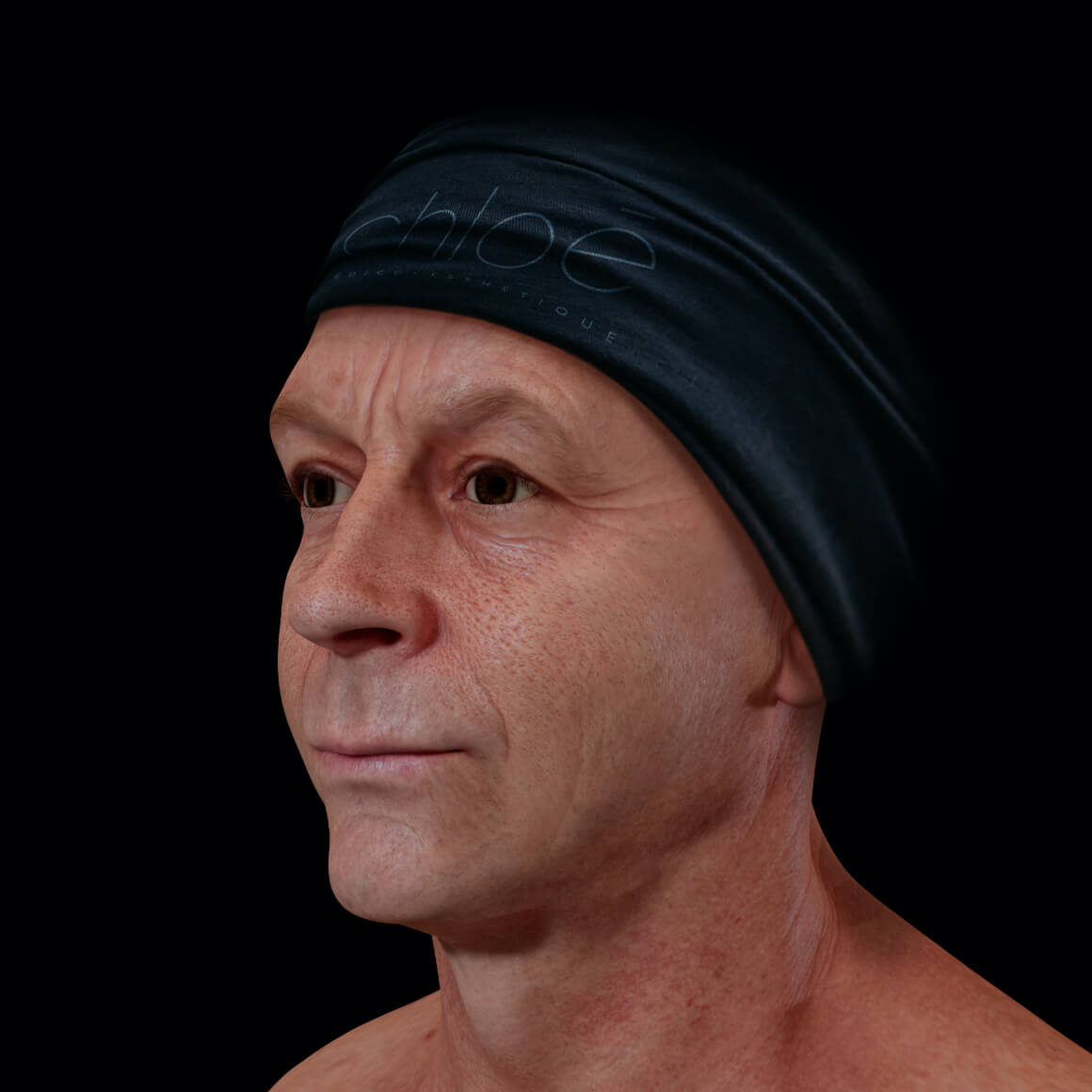 A male patient from Clinique Chloé positioned at an angle with dilated pores on the skin of his face