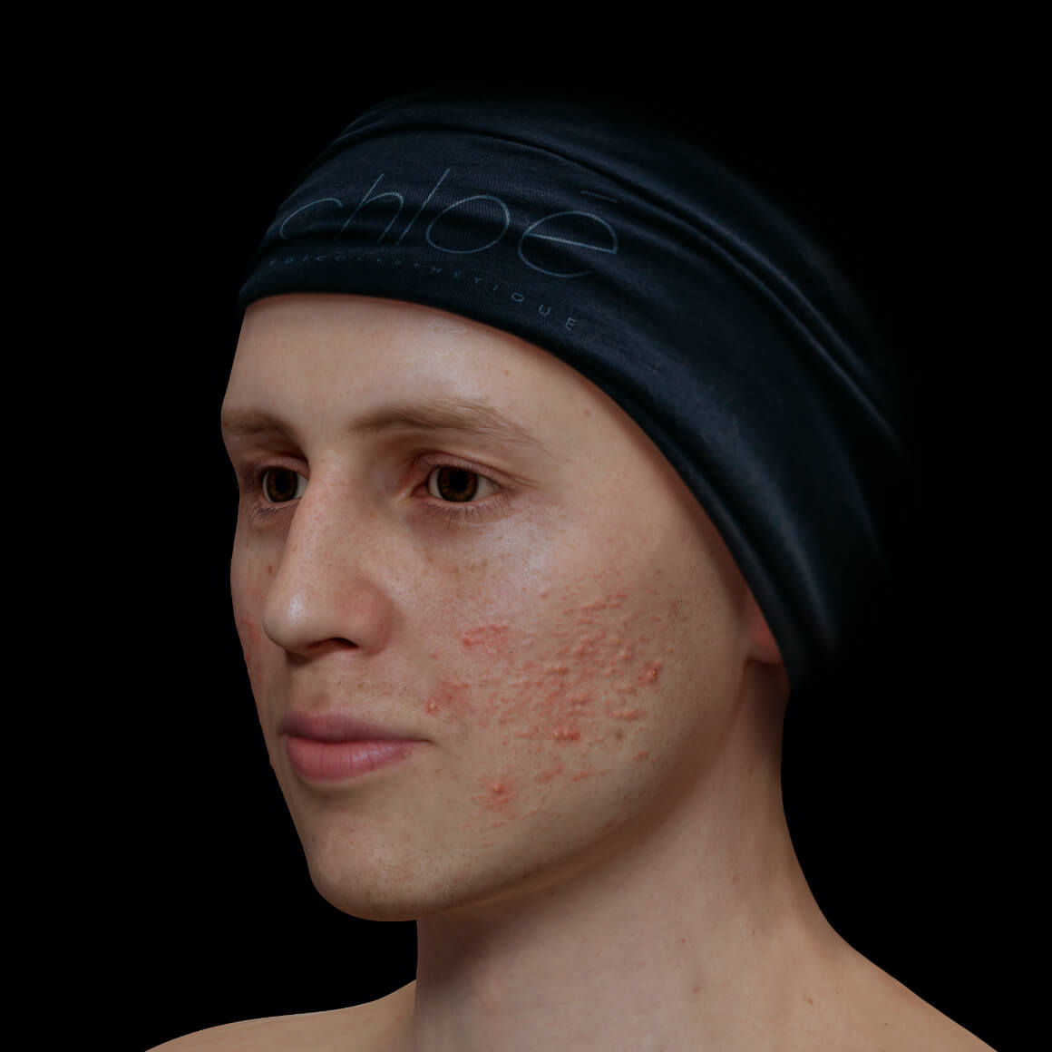 Angled Clinique Chloé male patient with active acne on his face
