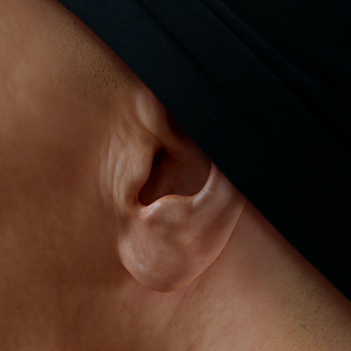 Left earlobe of a patient from Clinique Chloé positioned sideways after dermal filler injections for earlobe correction