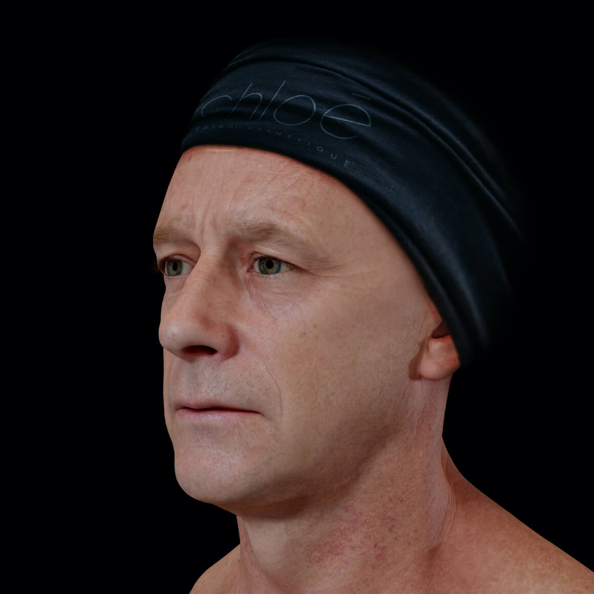 Male patient at Clinique Chloé positioned at an angle after platelet-rich plasma treatments, or PRP, for wrinkle reduction