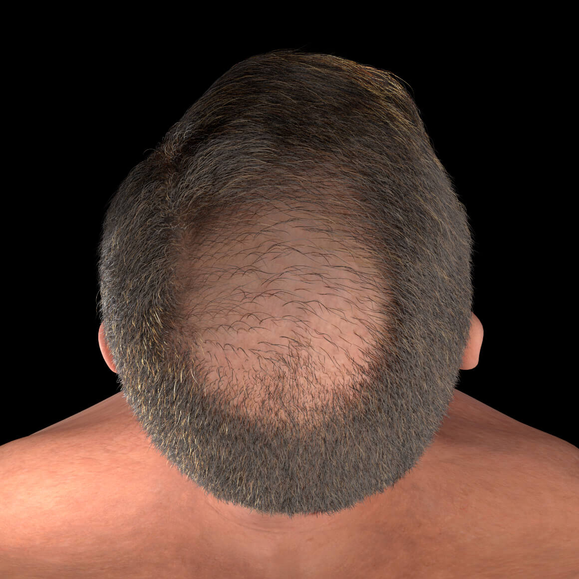 Scalp of a Clinique Chloé male patient showing thinning hair