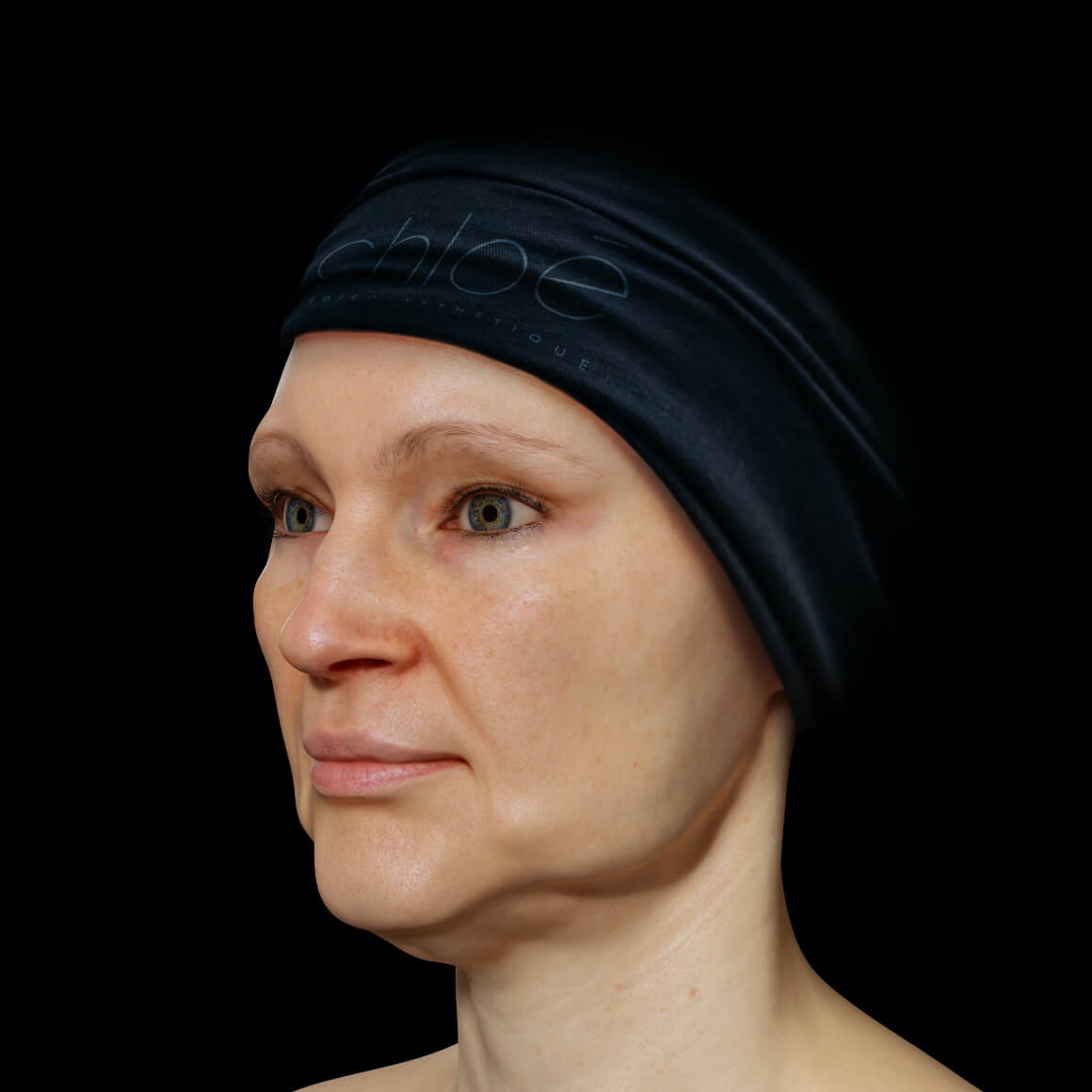 Clinique Chloé female patient positioned at an angle with sagging in the jawline area