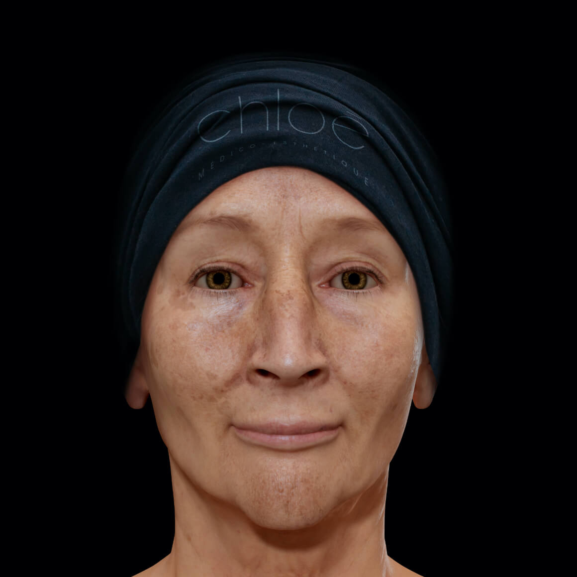 Female patient at Clinique Chloé front view with melasma on her face