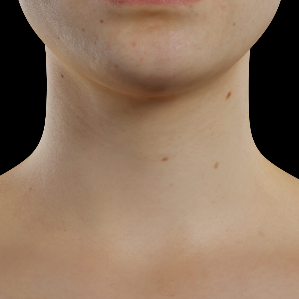 A female patient from Clinique Chloé facing front after injections of Skinboosters to plump the skin of the neck