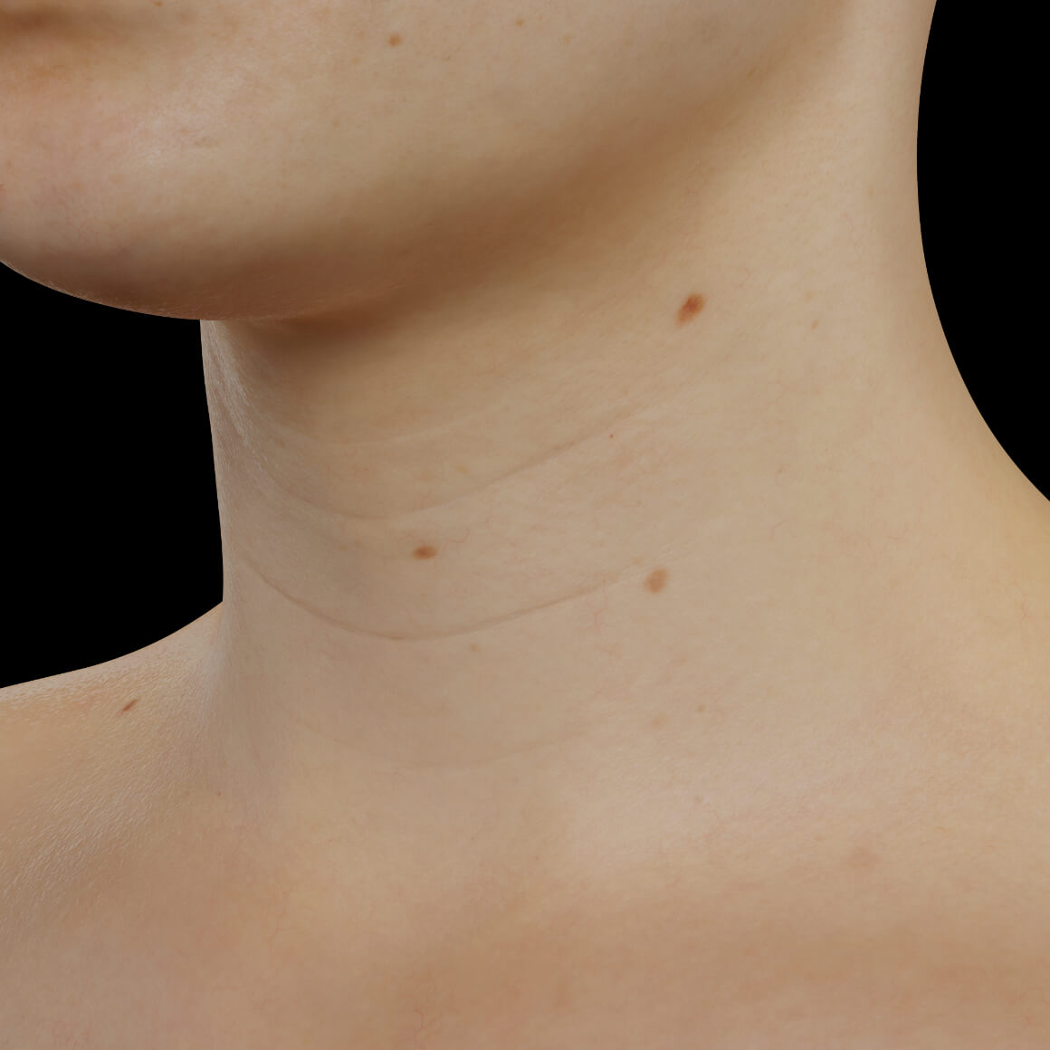 A female patient from Clinique Chloé positioned at an angle showing wrinkles in the neck area