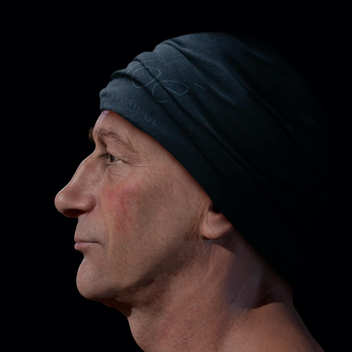 A male Clinique Chloé patient positioned sideways showing rosacea on his cheeks