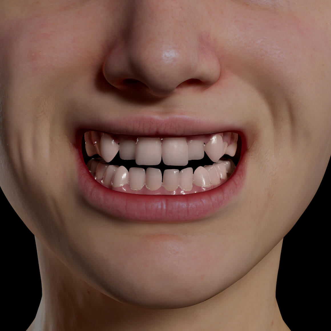 Smile of a Clinique Chloé patient positioned face-on showing crooked and misaligned teeth