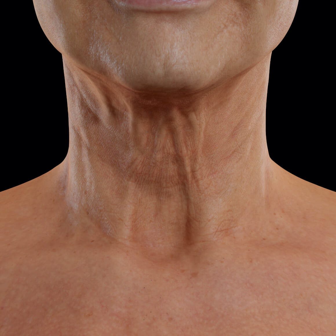 Female patient from Clinique Chloé facing front showing laxity in the skin of the neck 