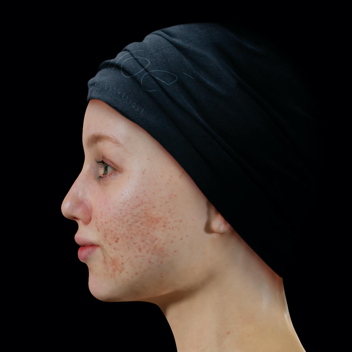 Patiente de la Clinique Chloé positionnée de côté ayant de l'acné active sur le visage 