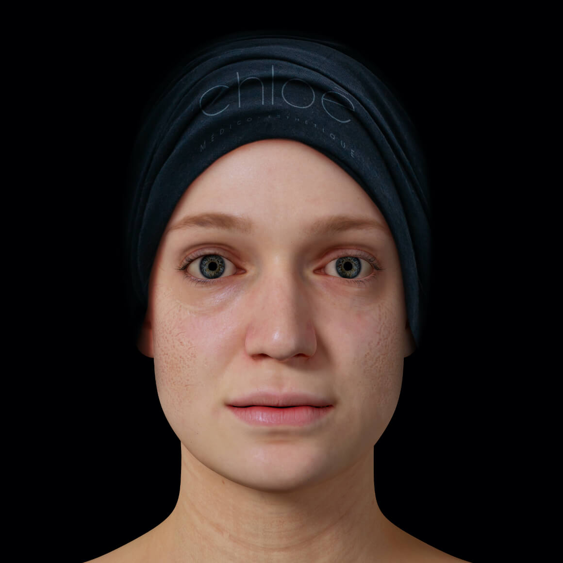 Patiente de la Clinique Chloé positionnée de face ayant des cicatrices d'acné sur le visage 