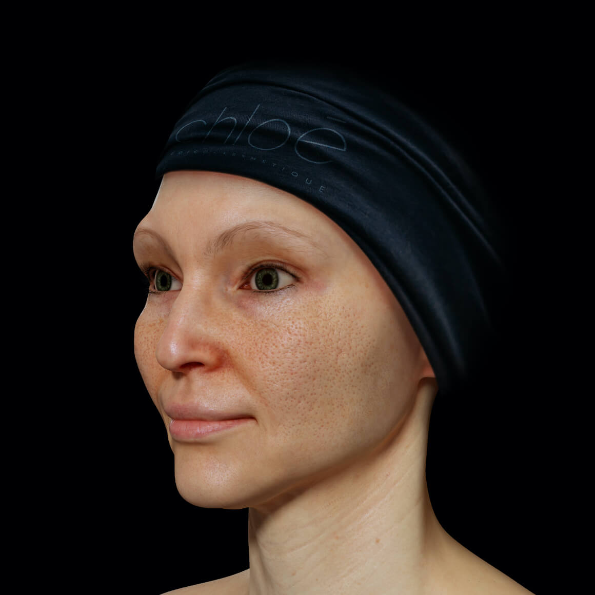 Patiente de la Clinique Chloé positionnée en angle ayant une peau du visage montrant des pores dilatés 