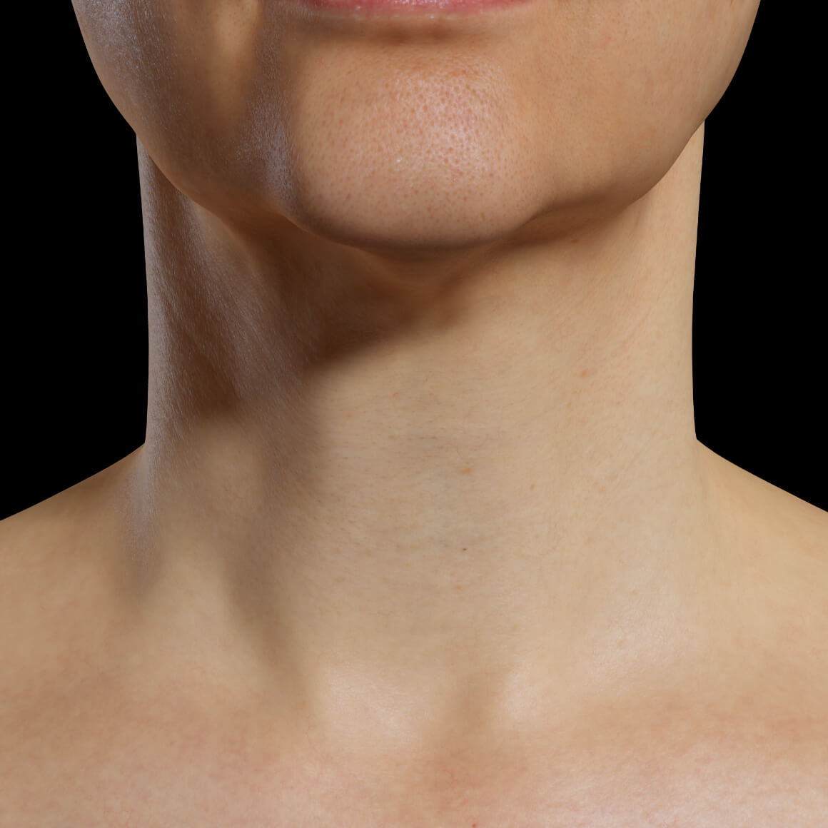 Une patiente de la Clinique Chloé positionnée de face après des traitements au laser Fotona 4D pour le raffermissement du cou
