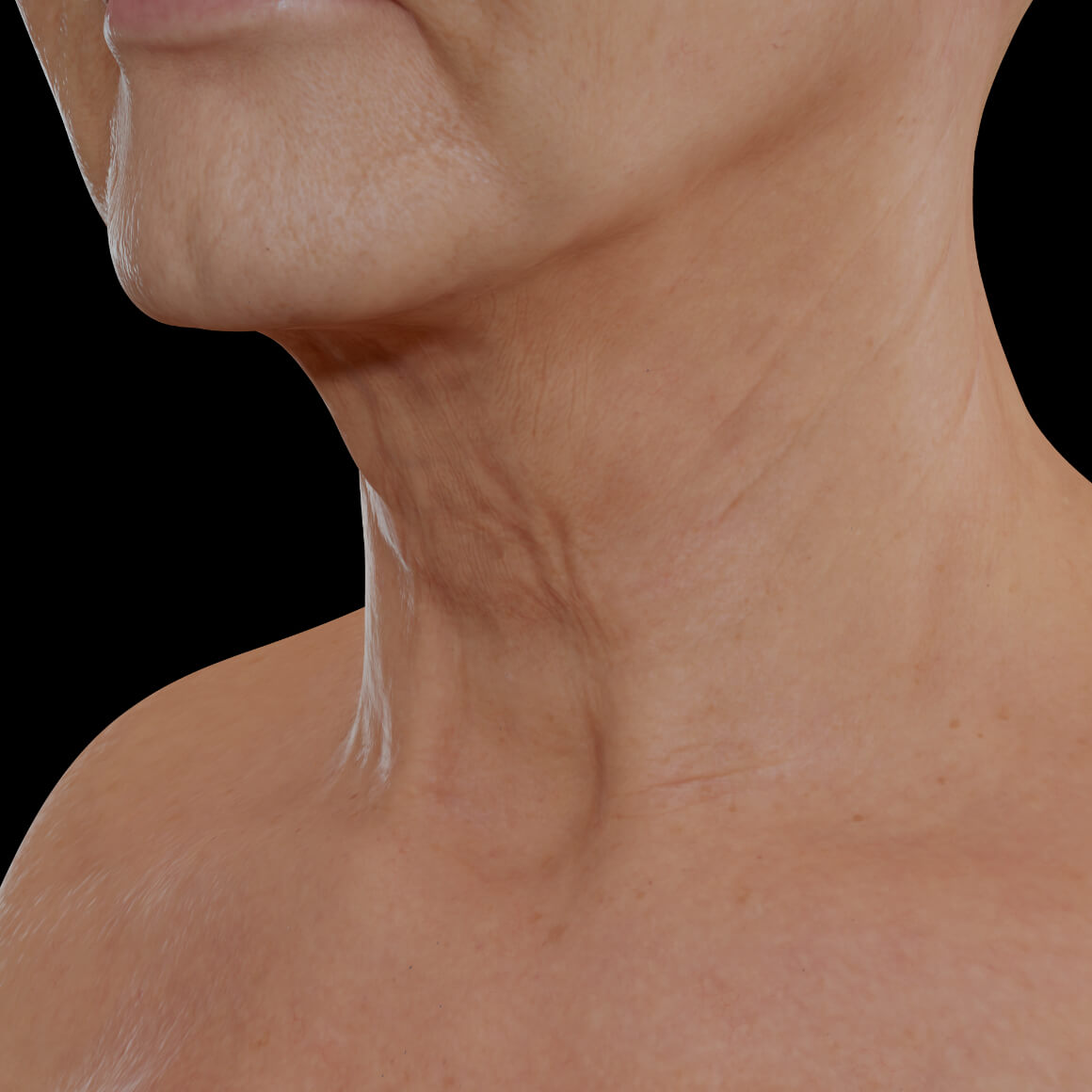 Patiente de la Clinique Chloé positionnée en angle après des injections du Sculptra pour le raffermissement du cou 