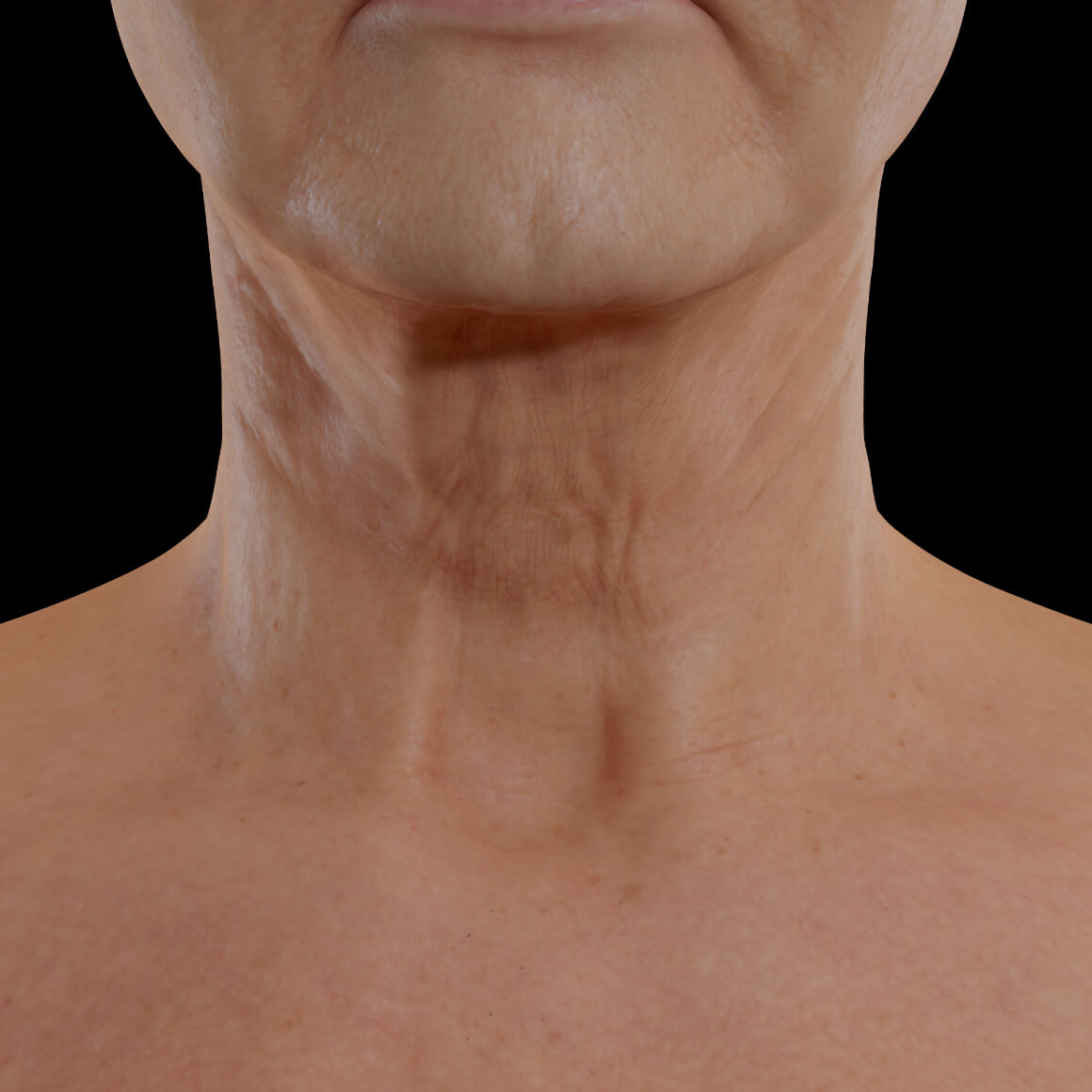 Patiente de la Clinique Chloé positionnée de face après des injections du Sculptra pour le raffermissement du cou 