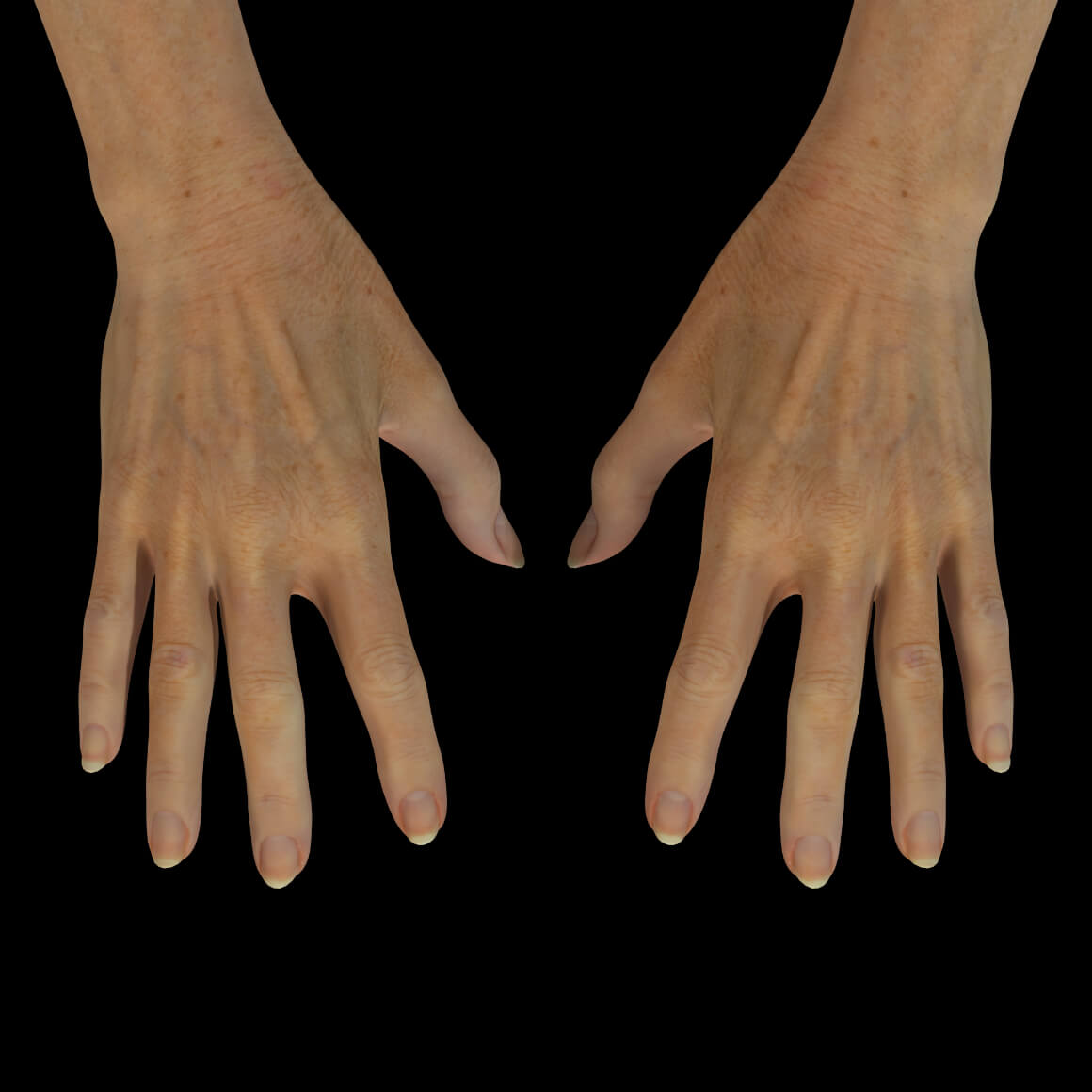 Hands of a Clinique Chloé female patient after an IPL photorejuvenation treatment to remove dark spots