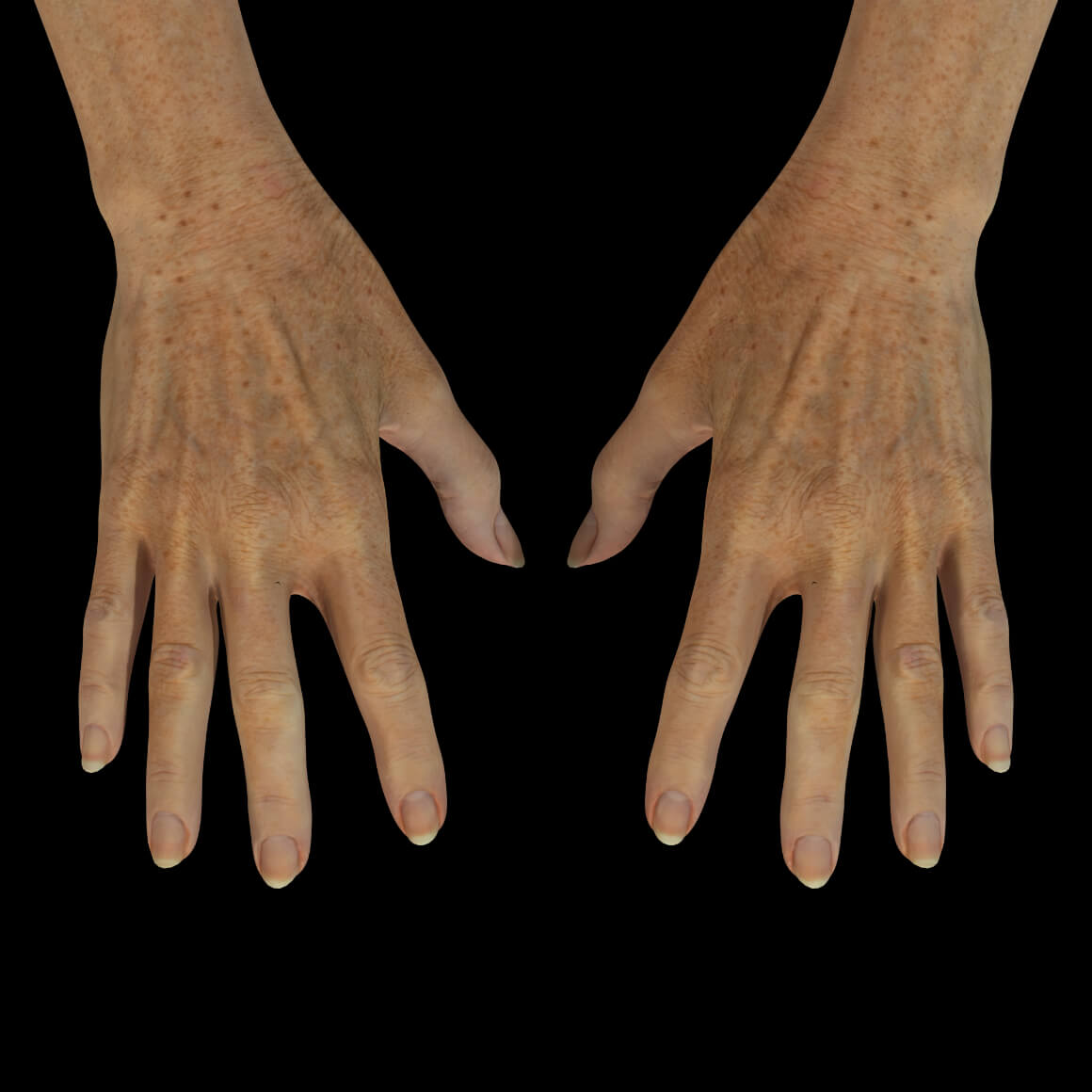 Hands of a Clinique Chloé female patient showing pigmented lesions