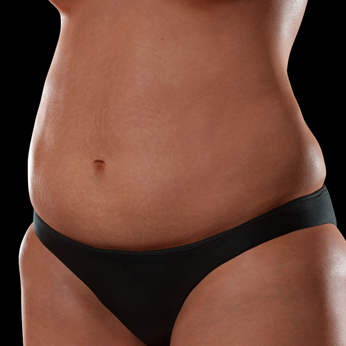 Female patient from Clinique Chloé positioned at an angle after fractional laser treatments for stretch marks 