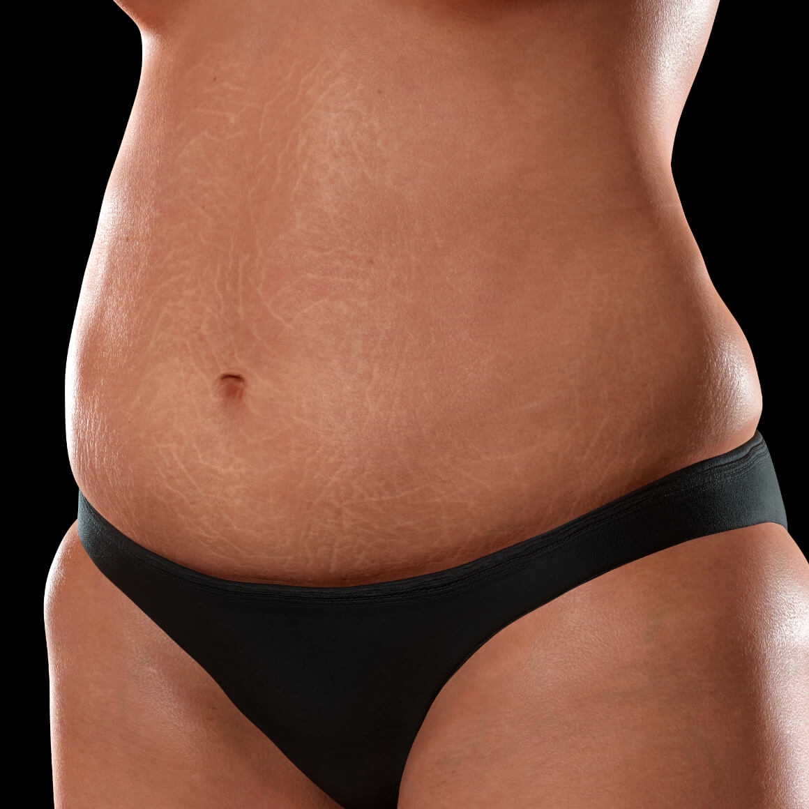Female patient from Clinique Chloé positioned at an angle with stretch marks on her abdomen 