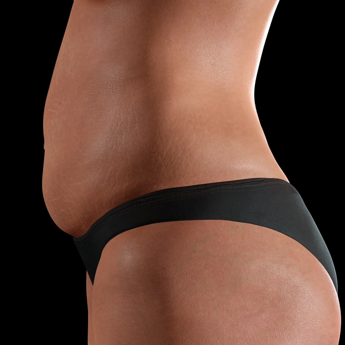 Female patient from Clinique Chloé positioned sideways with stretch marks on her abdomen 