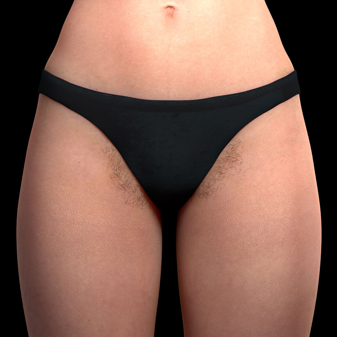 A female patient from Clinique Chloé facing front with unwanted hair in the bikini area