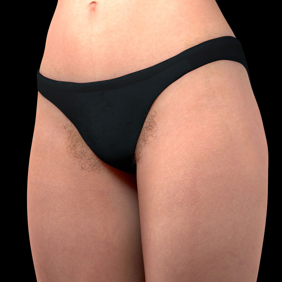 Patiente de la Clinique Chloé positionnée en angle ayant des poils indésirables dans la région du bikini 