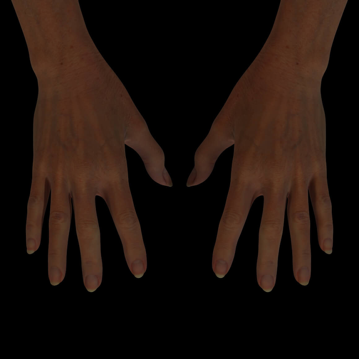 Mains d'une patiente de la Clinique Chloé après des injections de Radiesse pour leur rajeunissement