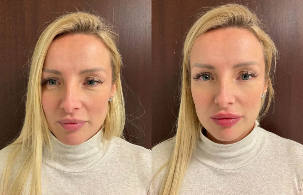 Une Augmentation des Lèvres a Montreal: Avant et Après
